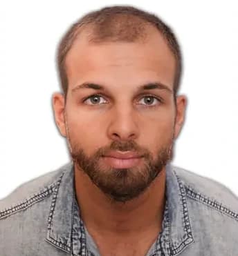 Photo avant la greffe de cheveux