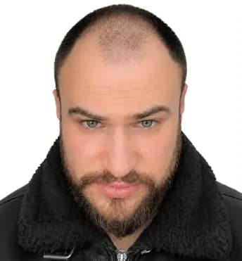 Photo avant la greffe de cheveux